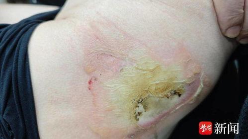 深二度烧伤图片,创伤后的皮肤修复与护理揭秘